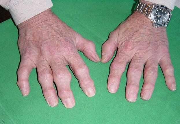 Artrose dos dedos