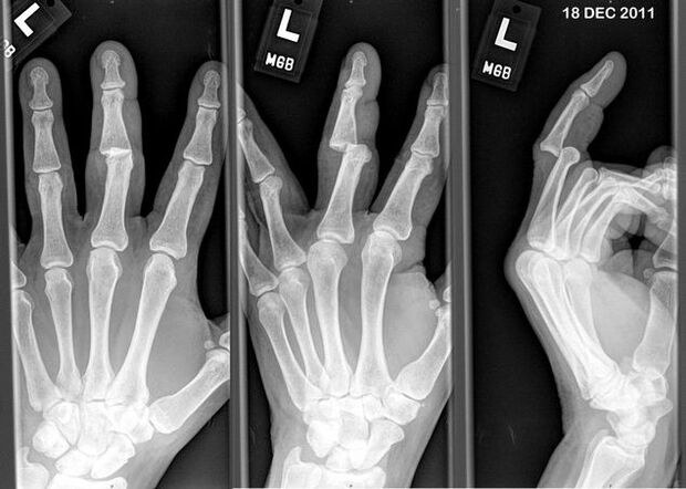 Radiografía dos dedos dislocados