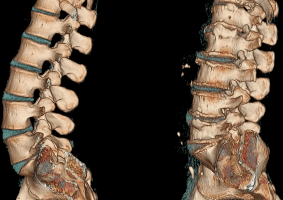 Osteocondrose