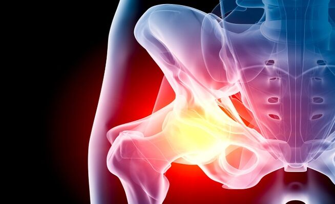 Osteoartrite da articulación da cadeira