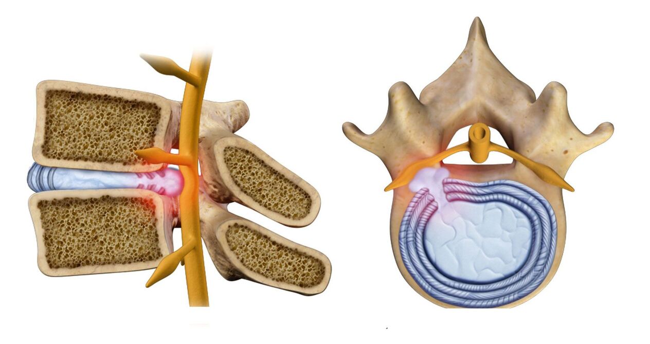 Hernia espinal na osteocondrose torácica
