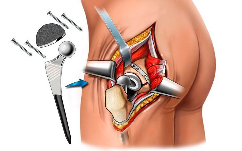 Instalación dunha endoprótese - unha solución cirúrxica ao problema da coxartrose