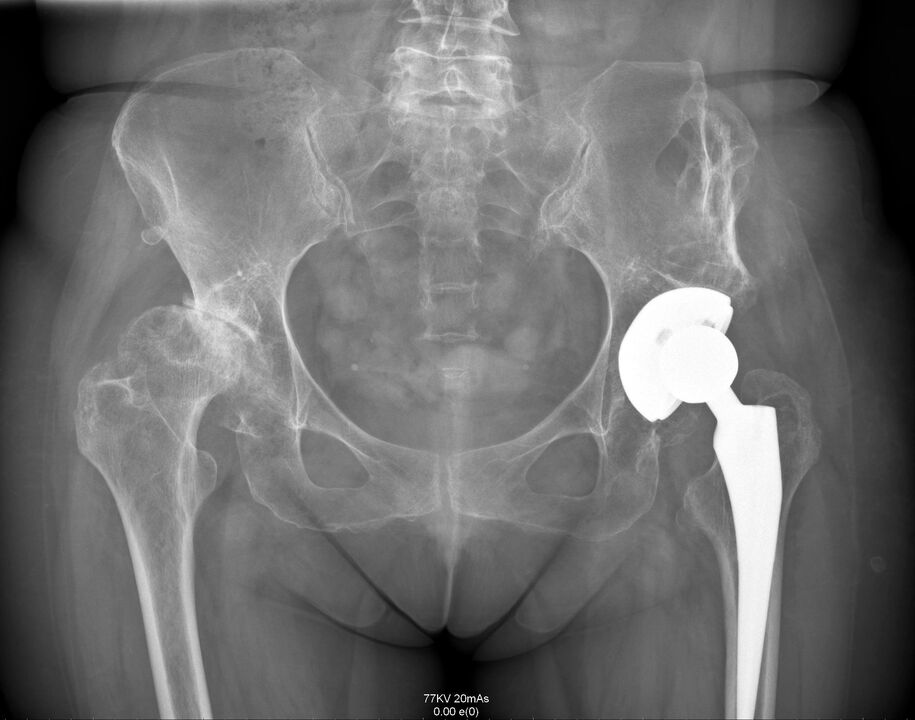 Radiografía da articulación da cadeira despois da endoprótesis