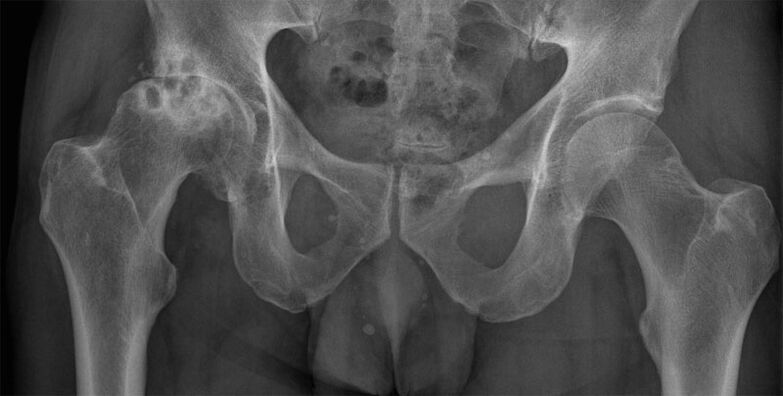 Radiografía da artrose deformante da articulación da cadeira