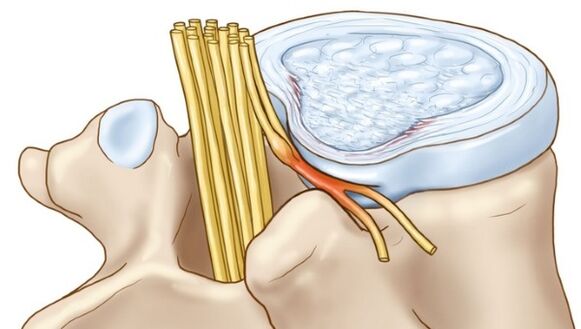 A osteocondrose lumbar pode levar a complicacións en forma de hernia intervertebral
