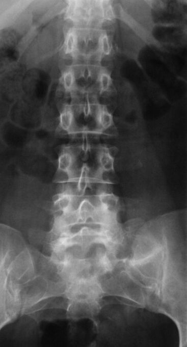 Para diagnosticar a osteocondrose lumbar, realízase unha radiografía
