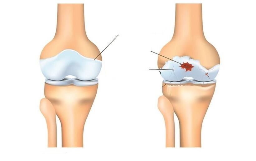 Saudable e paciente con articulacións de artrose