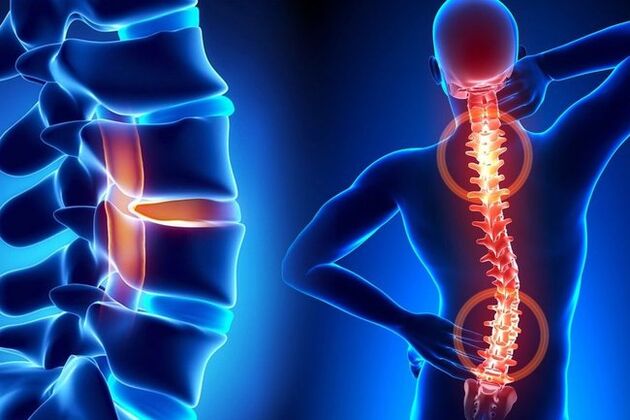 Osteocondrose da columna