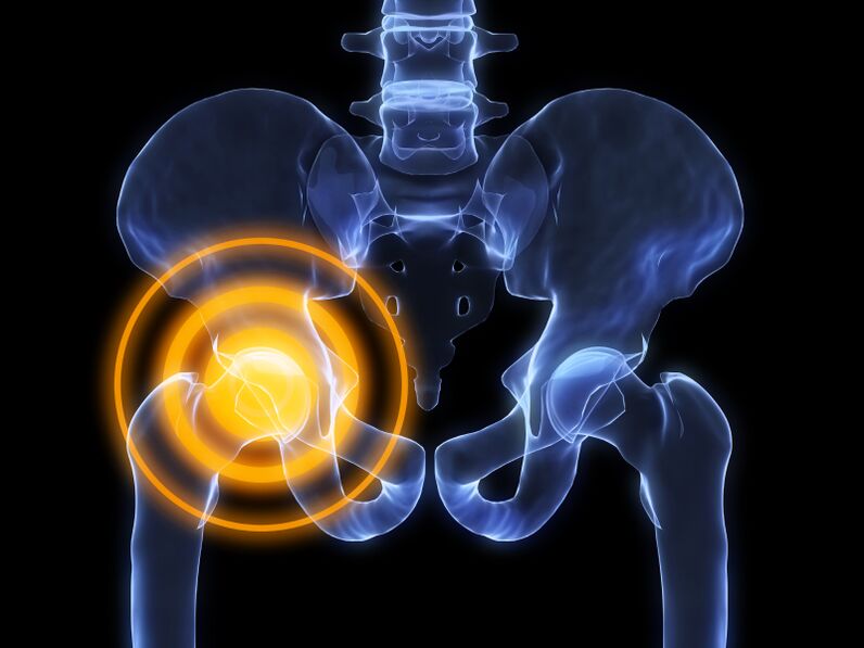 Osteoartrite da articulación da cadeira
